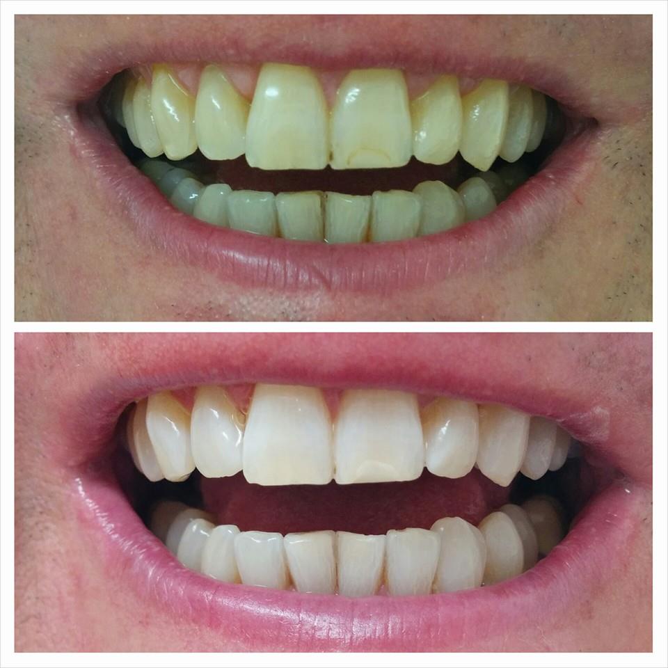 Consented before-and-after smile example