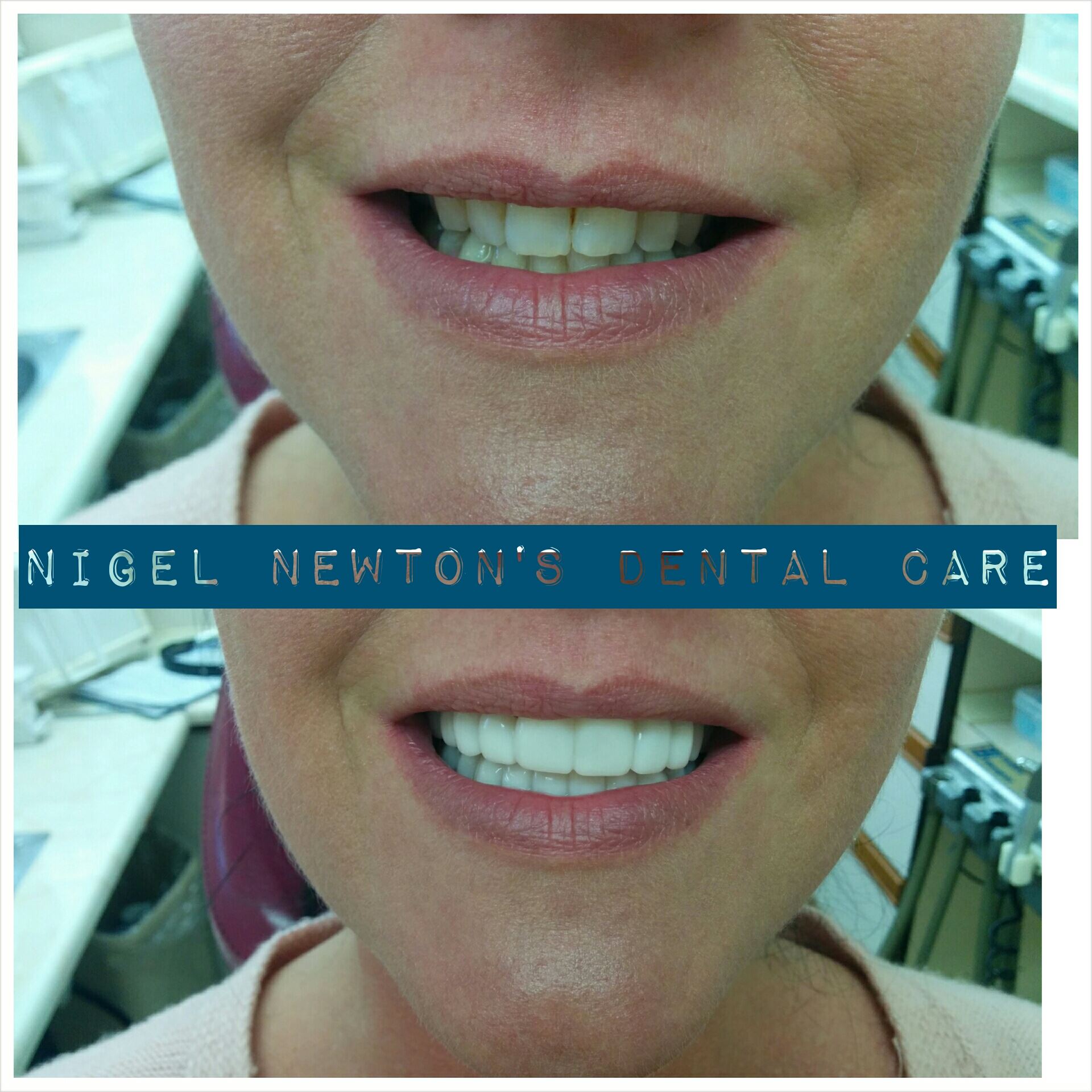 Consented before-and-after smile example