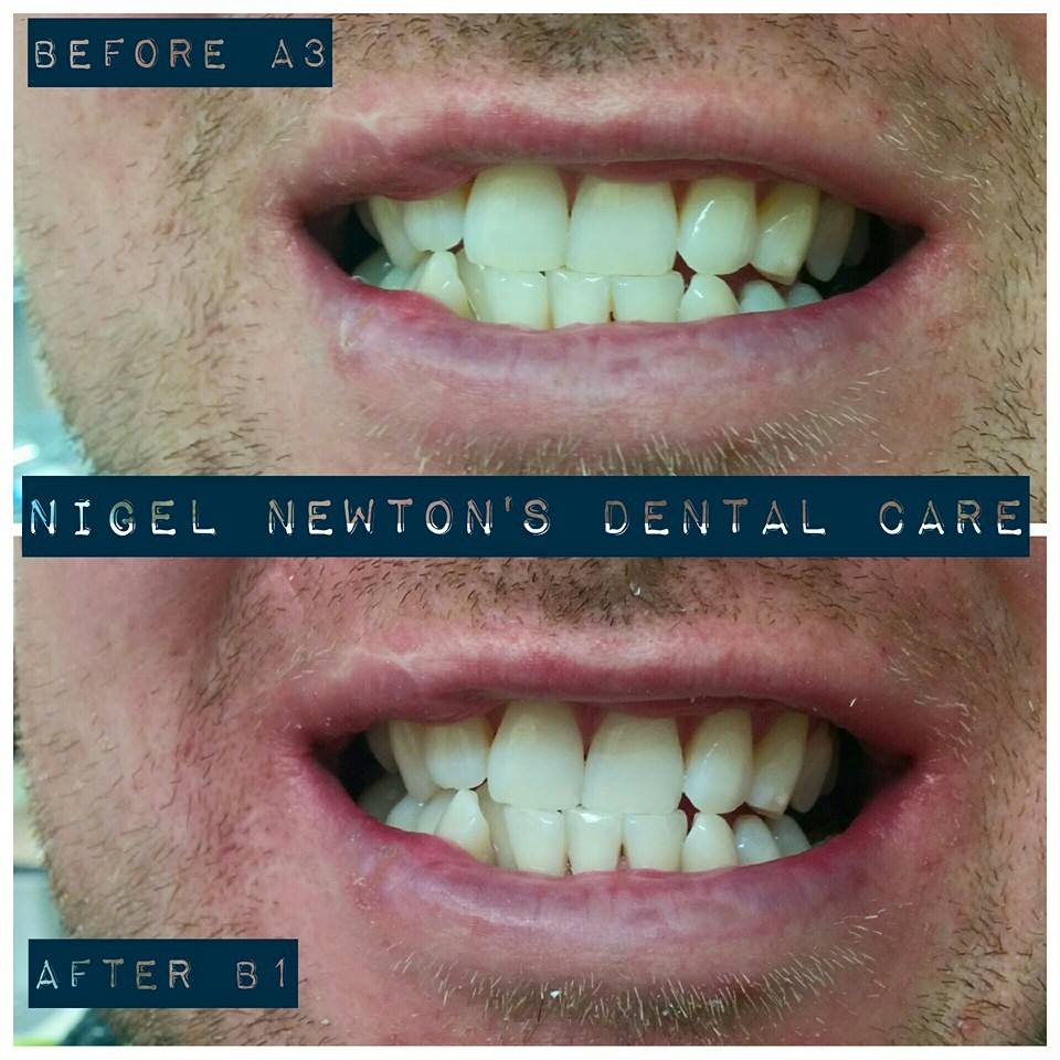 Consented before-and-after smile example