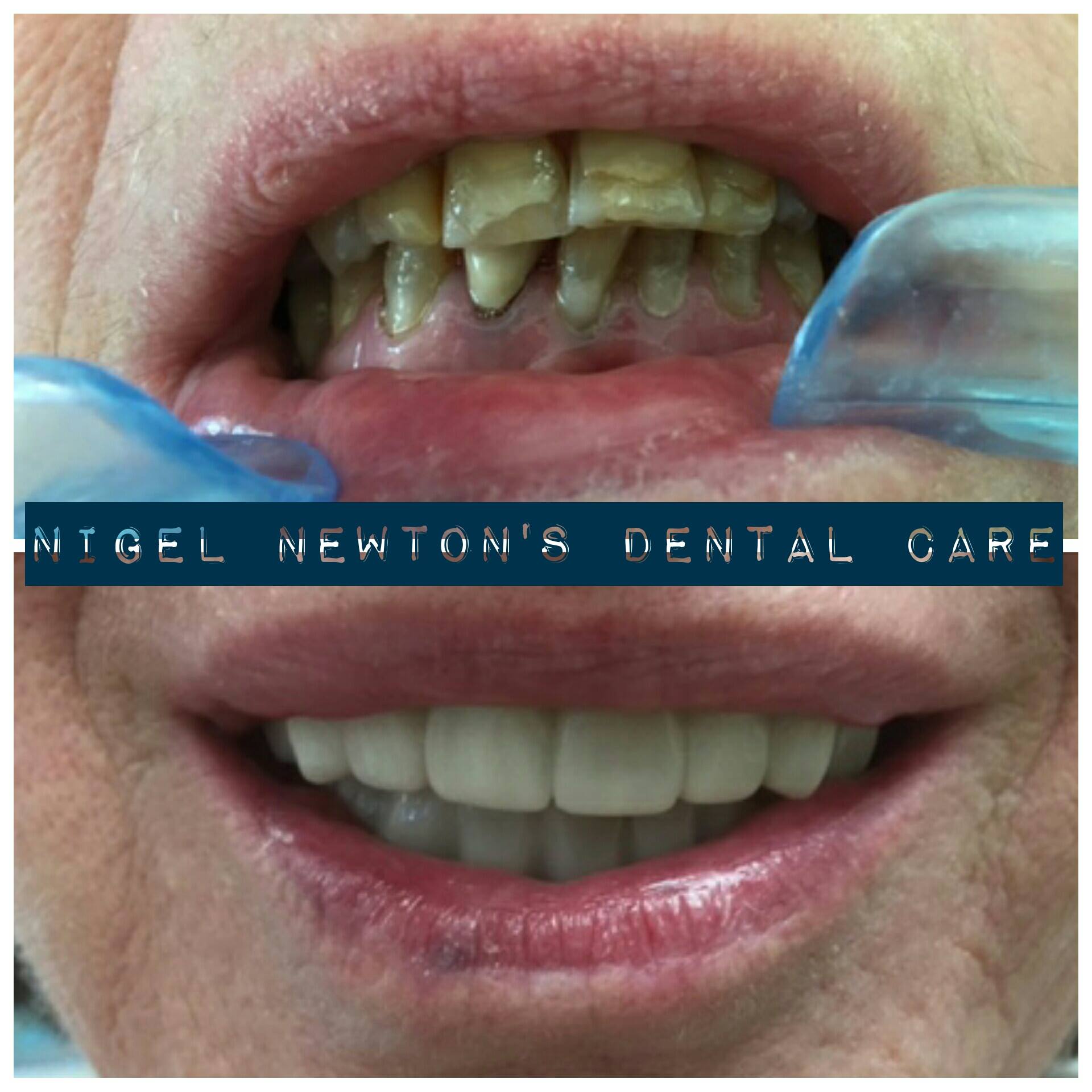 Consented before-and-after smile example