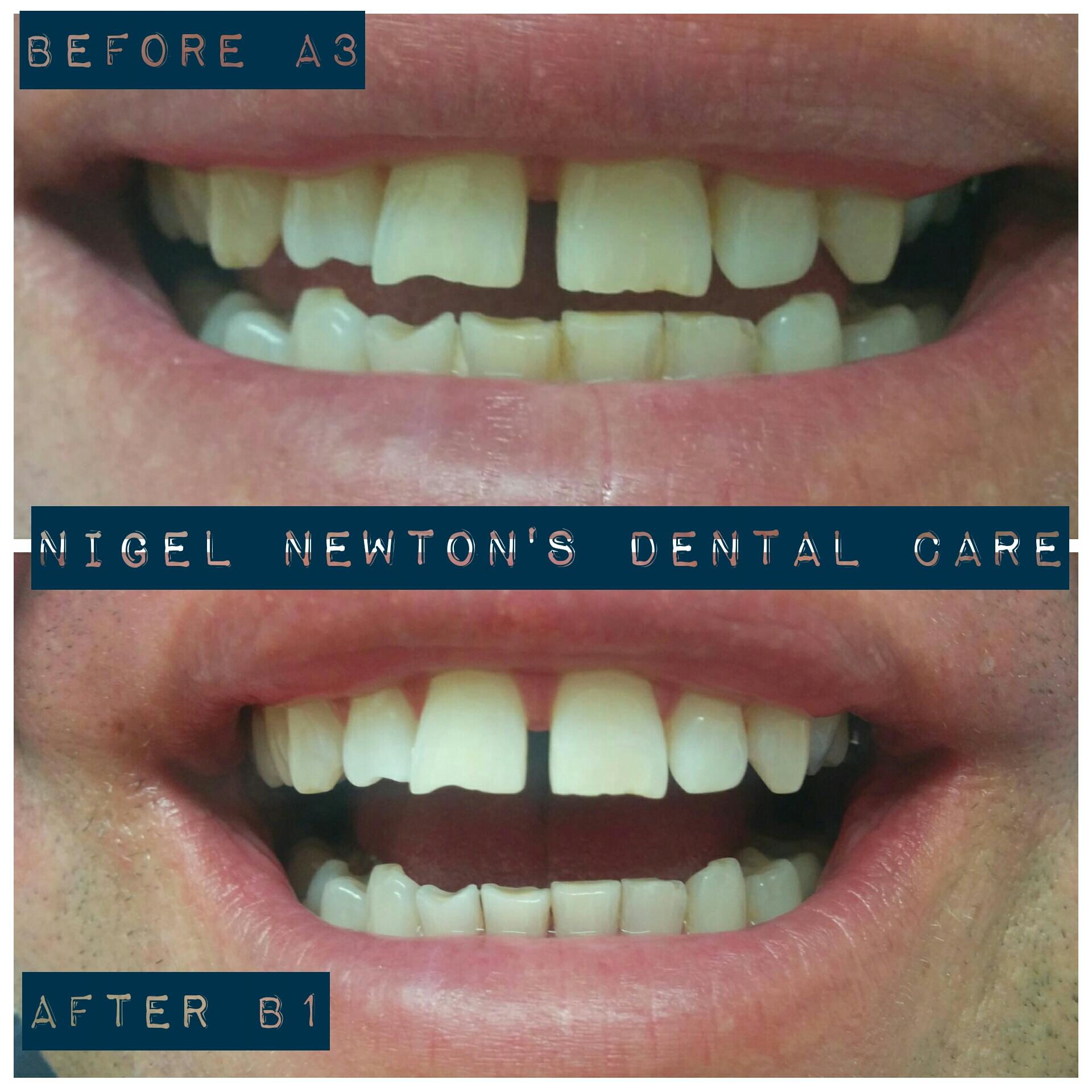 Consented before-and-after smile example