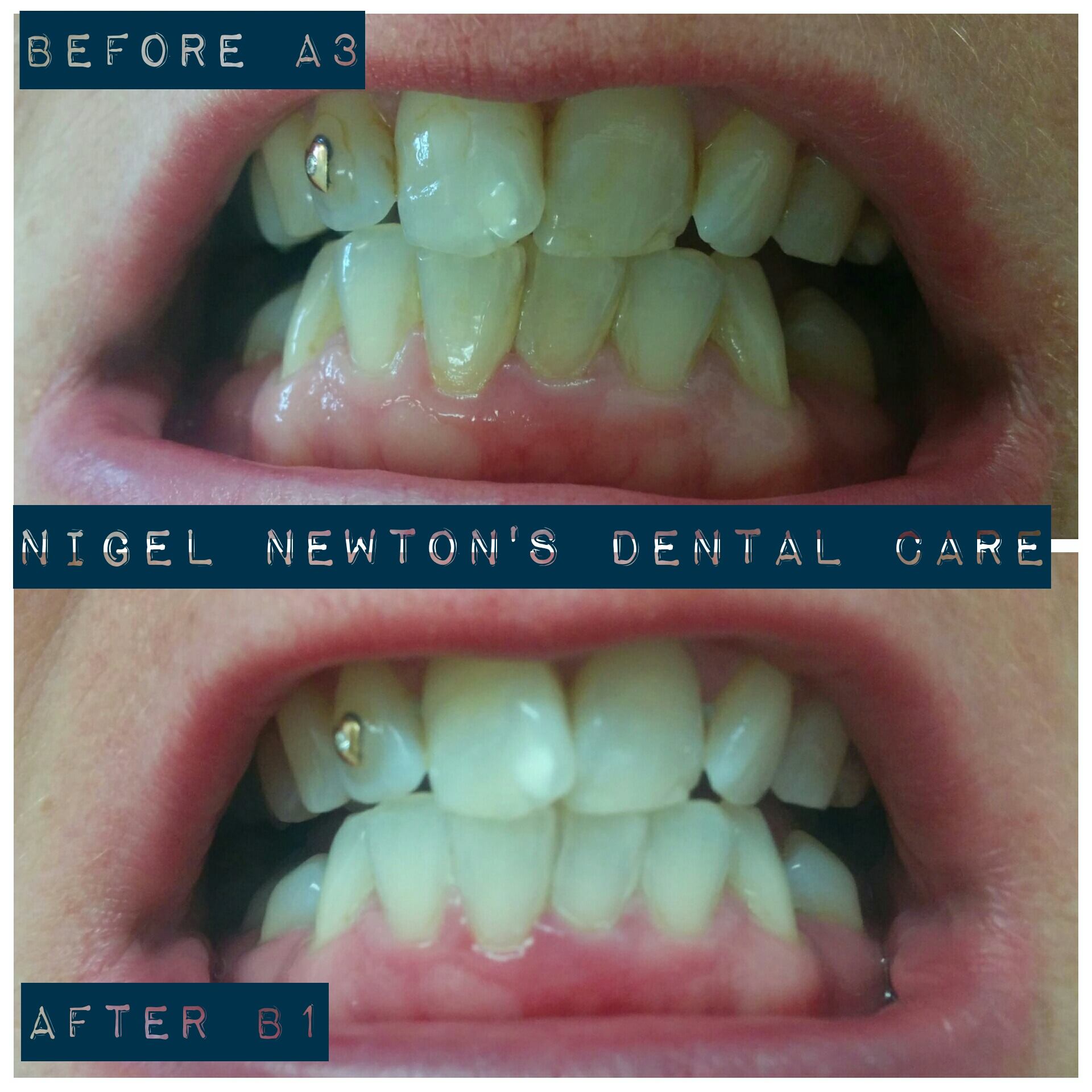 Consented before-and-after smile example